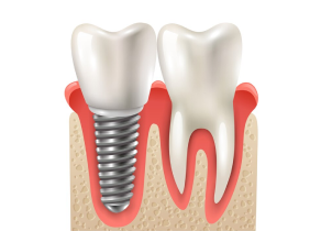 Dental Implants